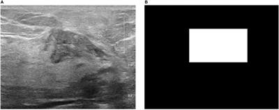 Deep learning radiomics model based on breast ultrasound video to predict HER2 expression status